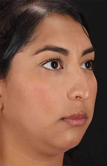Liquid Rhinoplasty Before & After Patient #6377