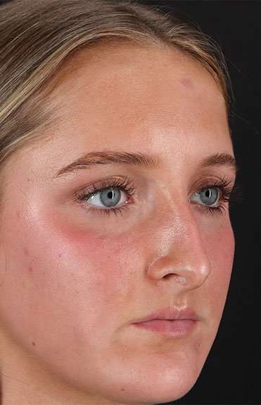 Liquid Rhinoplasty Before & After Patient #6388