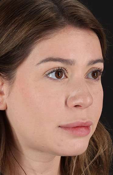 Liquid Rhinoplasty Before & After Patient #6399