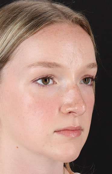 Liquid Rhinoplasty Before & After Patient #6425