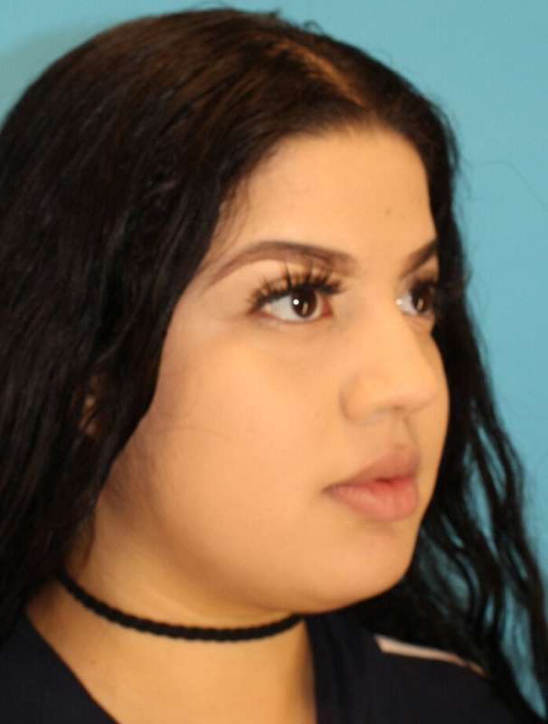 Buccal Fat Pad Before & After Patient #6436