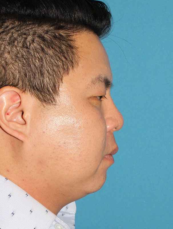 Buccal Fat Pad Before & After Patient #6441