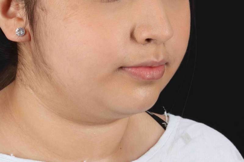 Buccal Fat Pad Before & After Patient #6452