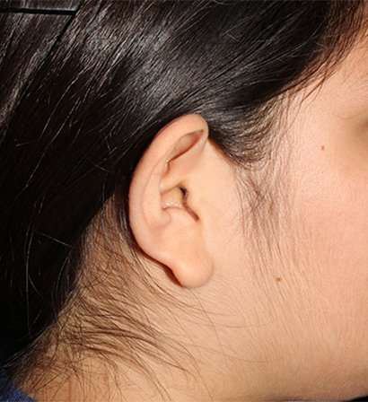 Otoplasty Before & After Patient #6501