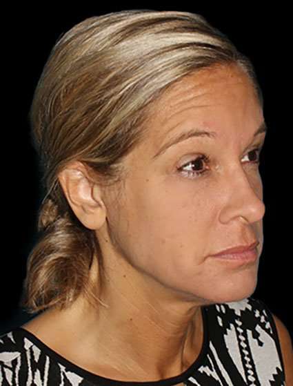 Neck Lift Before & After Patient #6517