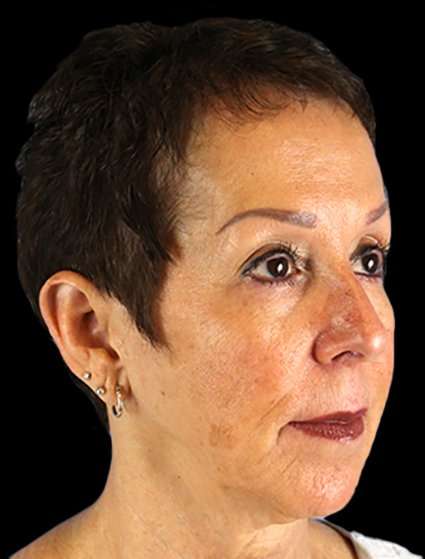 Neck Lift Before & After Patient #6528