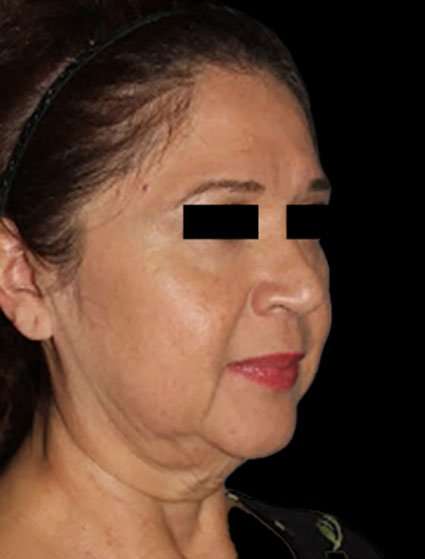 Neck Lift Before & After Patient #6539