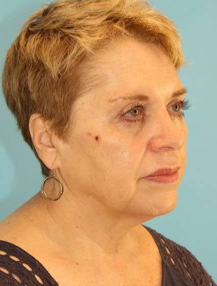 Neck Lift Before & After Patient #6565