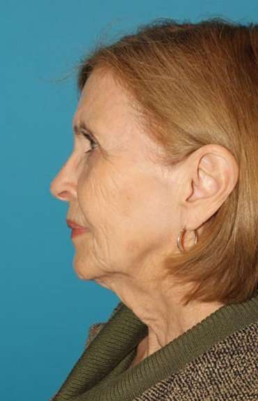 Neck Lift Before & After Patient #6579