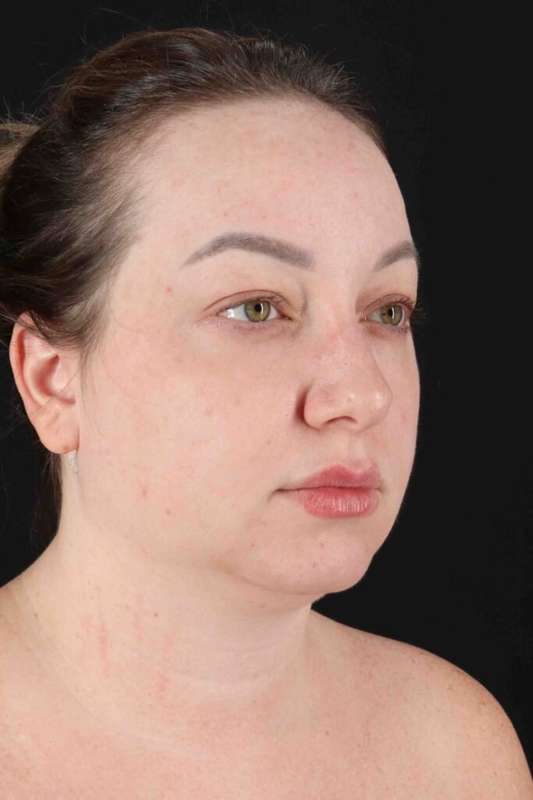 Neck Lift Before & After Patient #6598