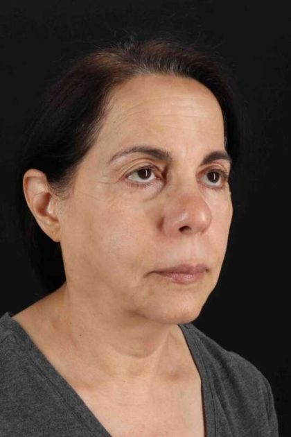 Neck Lift Before & After Patient #6642