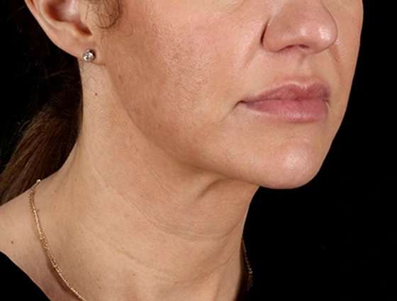 Neck Lift Before & After Patient #6676
