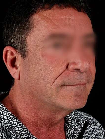 Neck Lift Before & After Patient #6698