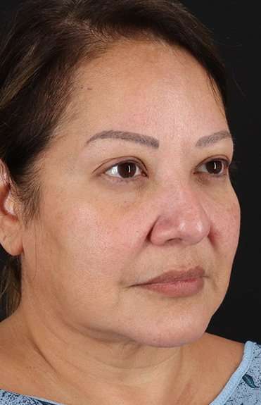 Neck Lift Before & After Patient #6709