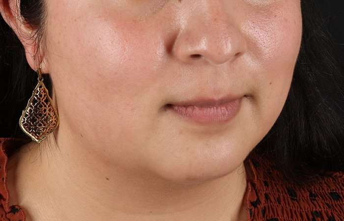 Neck Lift Before & After Patient #6743
