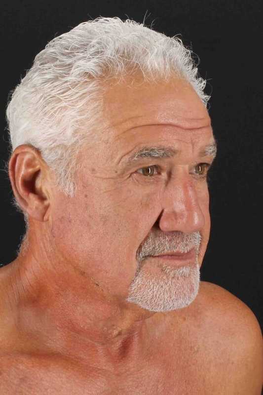 Neck Lift Before & After Patient #6788