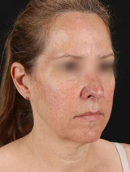 Neck Lift Before & After Patient #6838