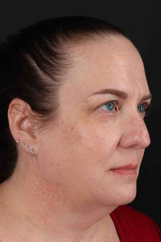 Neck Lift Before & After Patient #6898
