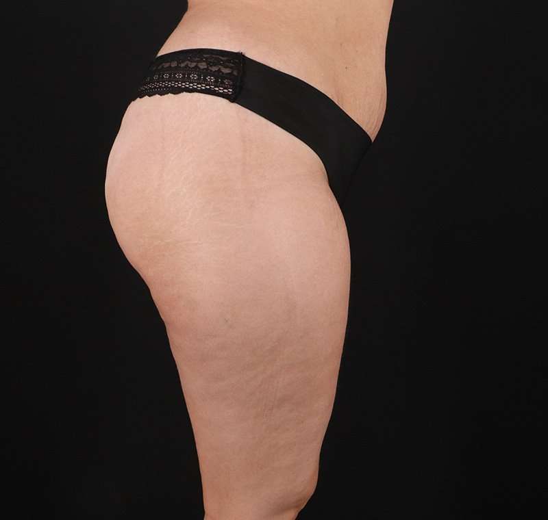 Liposuction Before & After Patient #1249