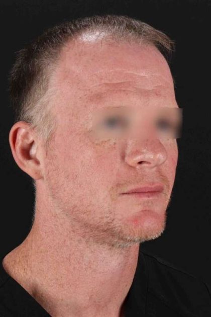CO2 Laser Before & After Patient #6931