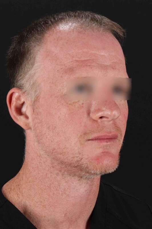 CO2 Laser Before & After Patient #6931