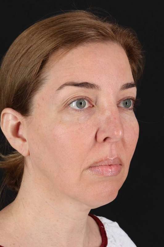 CO2 Laser Before & After Patient #6953
