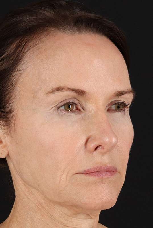 CO2 Laser Before & After Patient #6975