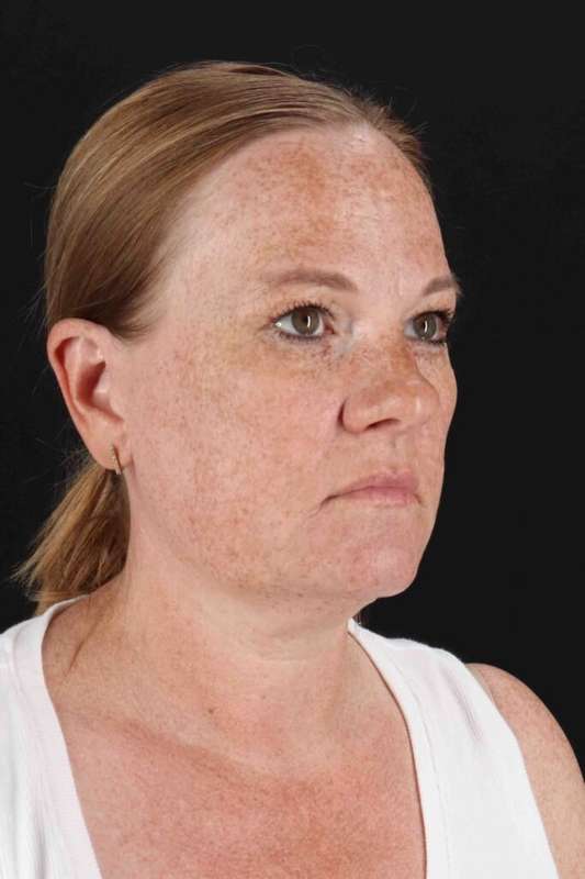 CO2 Laser Before & After Patient #6997