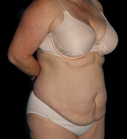 Abdominoplasty (Tummy Tuck) Before & After Patient #625