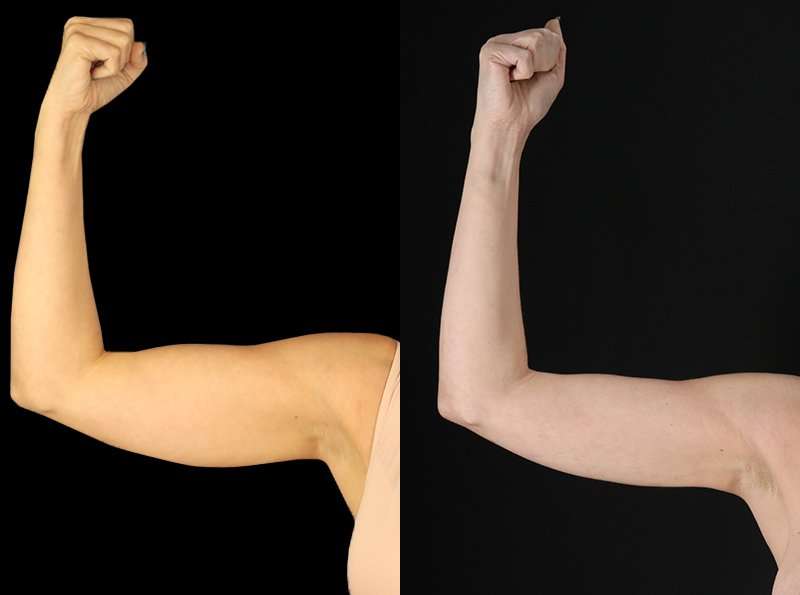 Liposuction Before & After Patient #1256