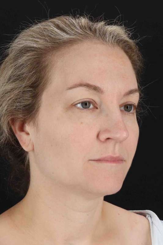 CO2 Laser Before & After Patient #7019