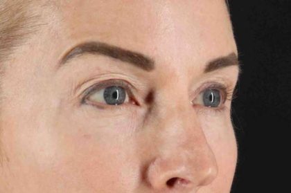 CO2 Laser Before & After Patient #7030