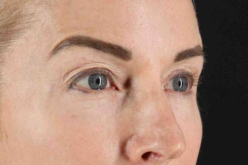 CO2 Laser Before & After Patient #7030