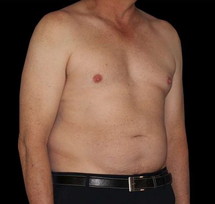 Liposuction Before & After Patient #1270