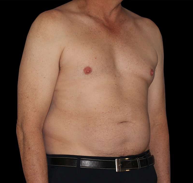 Liposuction Before & After Patient #1270