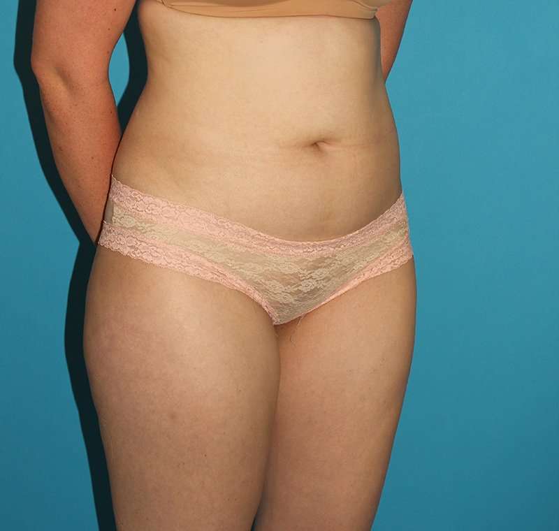Liposuction Before & After Patient #1281