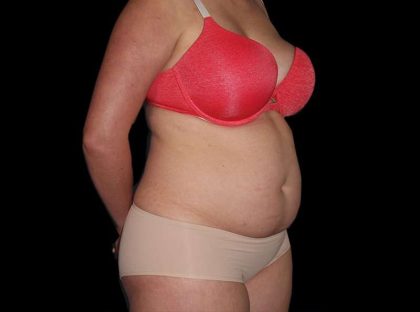 Liposuction Before & After Patient #1298
