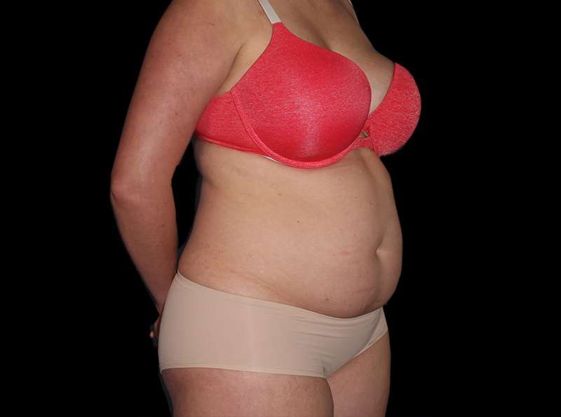 Liposuction Before & After Patient #1298