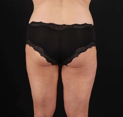 Liposuction Before & After Patient #1337