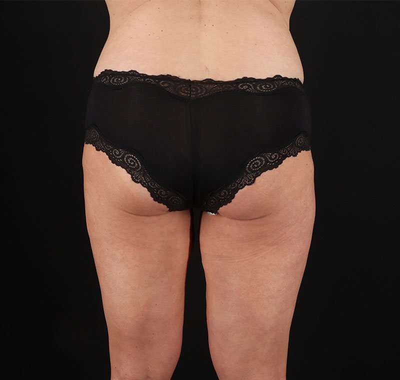 Liposuction Before & After Patient #1337