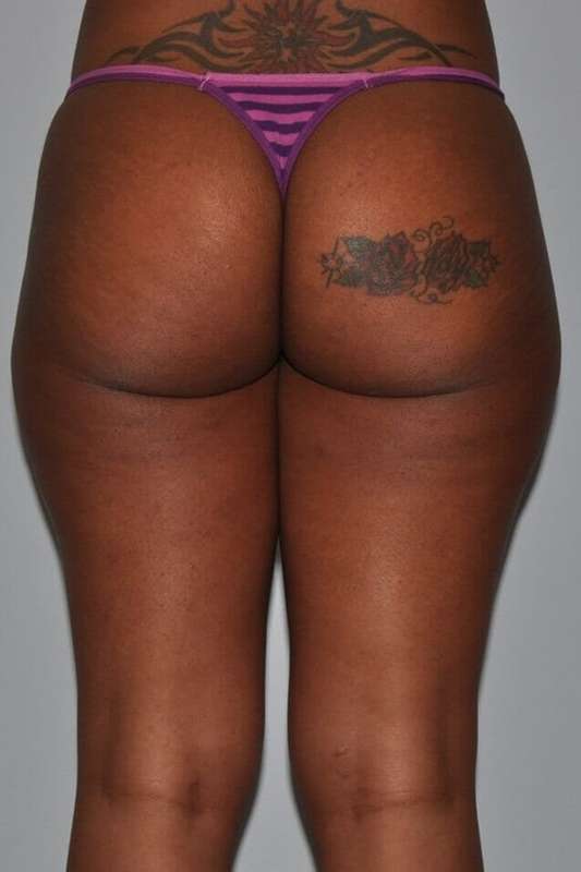 Liposuction Before & After Patient #1419