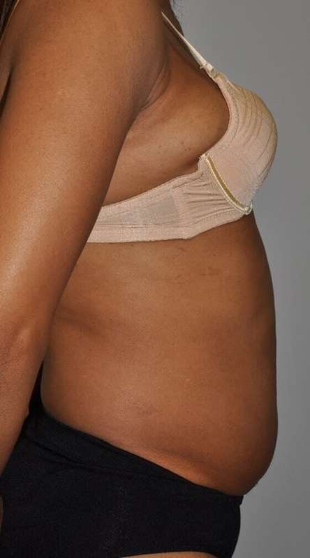 Liposuction Before & After Patient #1425