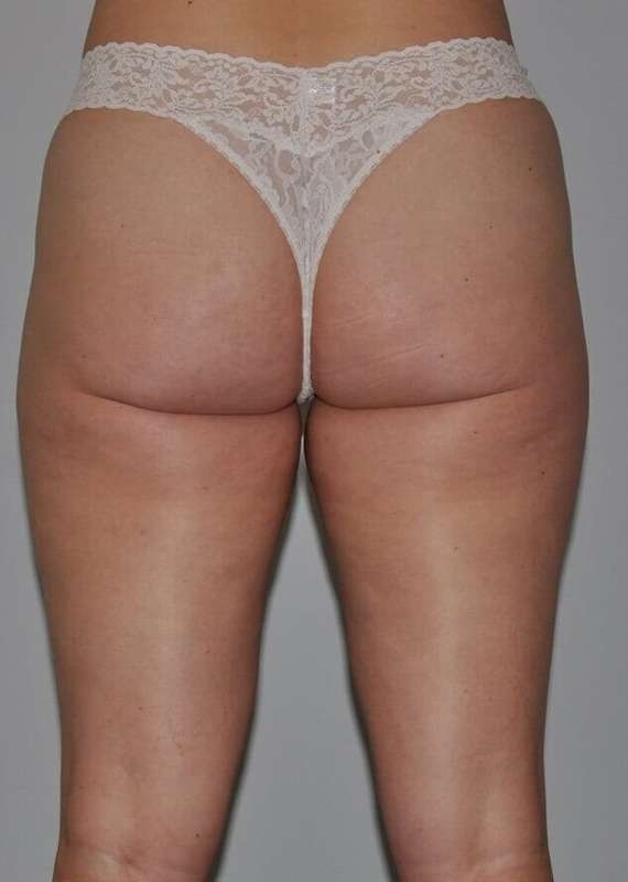 Liposuction Before & After Patient #1433