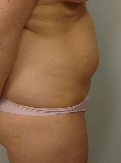 Liposuction Before & After Patient #1439
