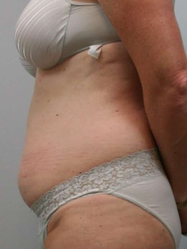 Liposuction Before & After Patient #1445