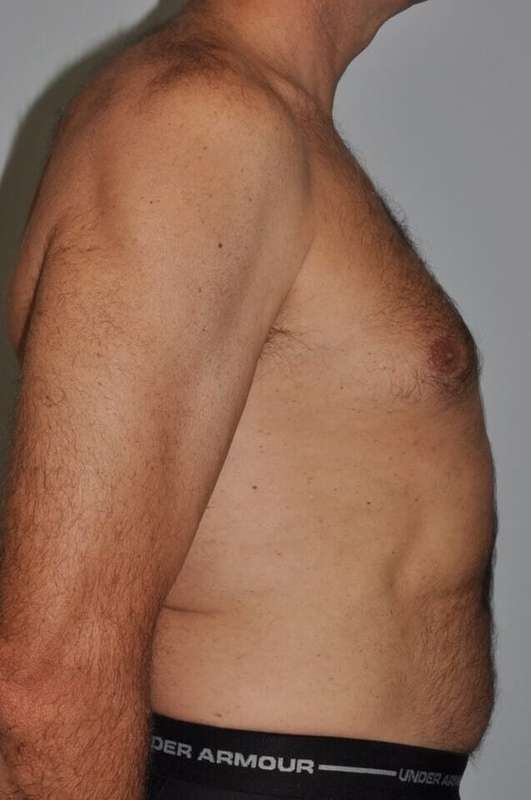 Liposuction Before & After Patient #1450