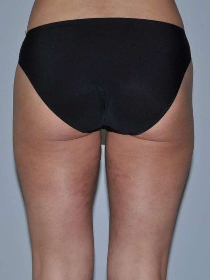 Liposuction Before & After Patient #1455