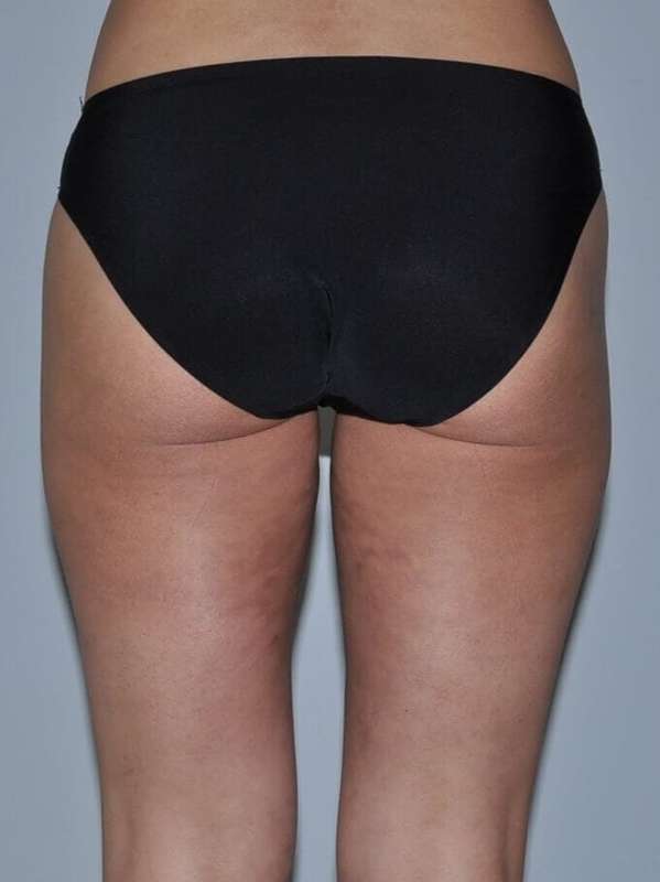 Liposuction Before & After Patient #1455