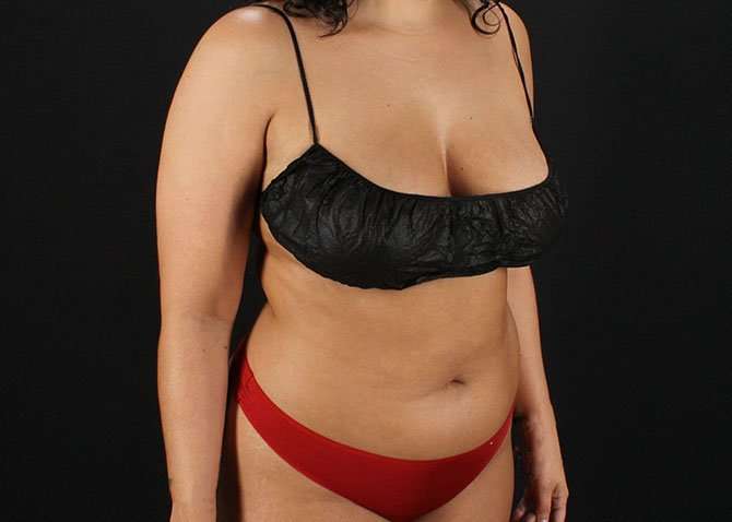Liposuction Before & After Patient #1469