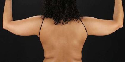 Liposuction Before & After Patient #1482